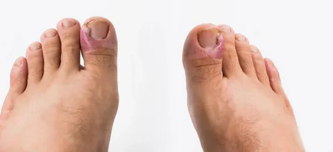 Infected or Painful Toenail? See Edinburgh Podiatrist