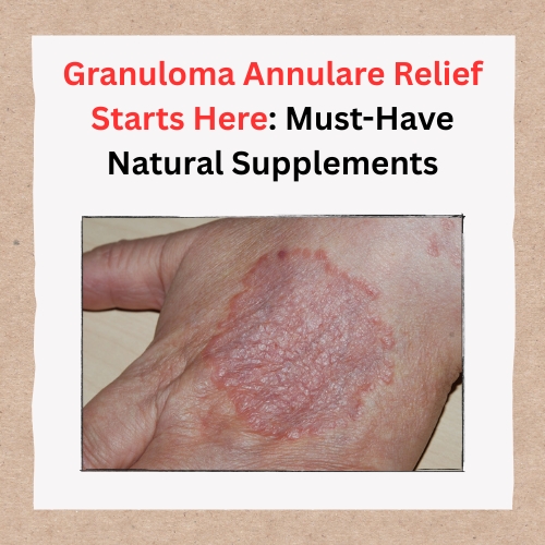 Granuloma Annulare Relief Starts Here