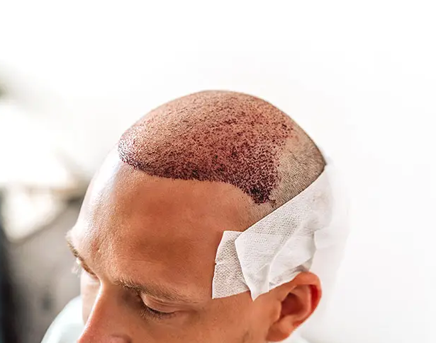 Hair Transplant Technique
