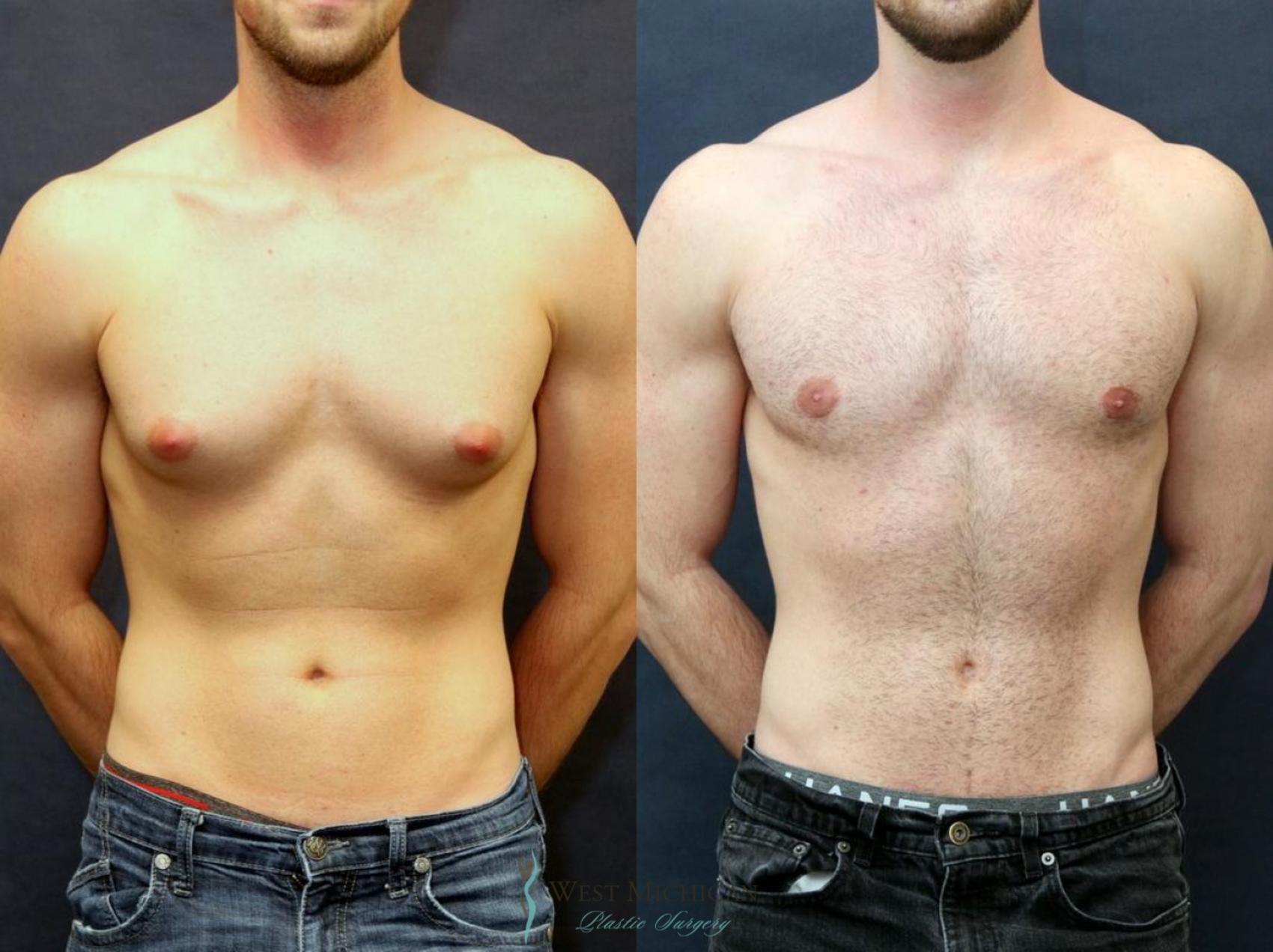 Gynecomastia Surgery in Delhi NCR