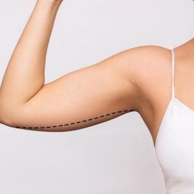 What-Are-the-Risks-of-Having-an-Arm-Lift