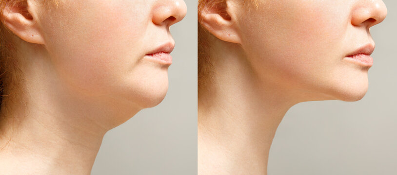 double chin liposuction in Islamabad