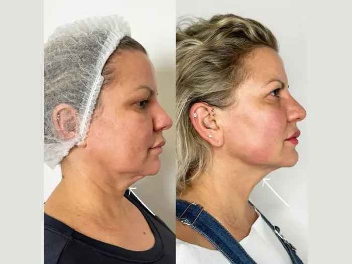The Top Reasons to Choose Endolift Treatment in Dubai in 2026