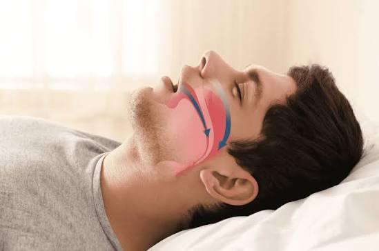 obstructive sleep apnea icd 10